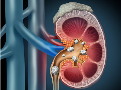 Kidney Stone Treatment by Dr. Sanjeev Kumar Jha Urologist at Star Hospital Siliguri